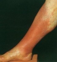 Рожистое воспаление ноги: лечение
