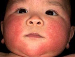 Как проявляется аллергия у грудничков?