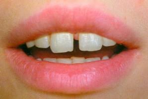 Щель между передними зубами