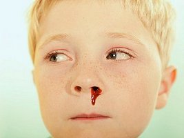 Кровь из носа у ребенка: причины