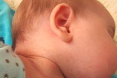 Сыпь на шее у ребенка