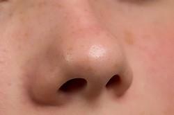 Сыпь вокруг носа