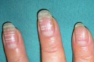 Что означают белые пятна на ногтях рук?