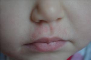 Раздражение вокруг рта у ребенка