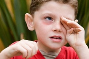 Красные круги под глазами у ребенка: причины