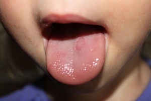 Причины язвочек на языке у ребенка