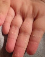 Сыпь на руках у ребенка