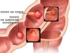 Полипы в кишечнике: симптомы
