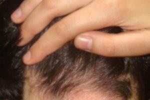 Псориаз волосистой части головы: причины и симптомы