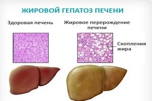 Симптомы жирового гепатоза печени