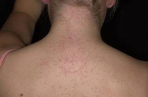 Сыпь на лице, спине и животе: классификация, лечение